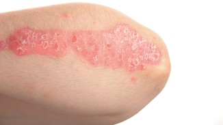 psoriasis elbow.jpg