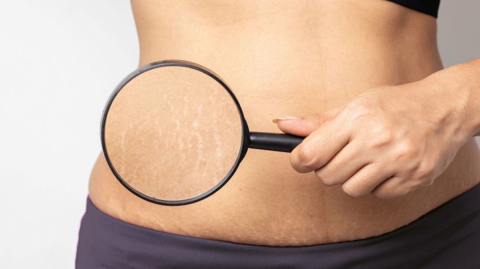 stretch marks magnifying glass.jpg