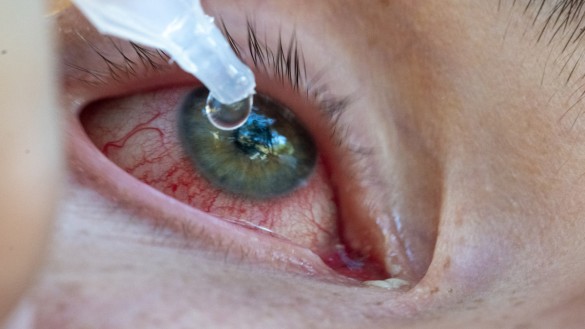 eye drops.jpg